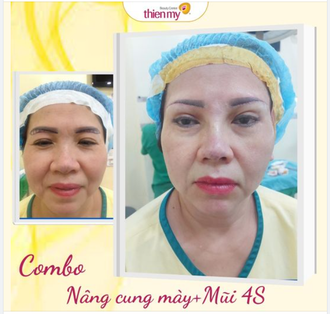 Nâng cung mày cắt bỏ phần da chùng, kéo căng da. ​​​​​​​Loại bỏ da chùng, nếp nhăn, mỡ thừa lấy lại đôi mắt trẻ trung.