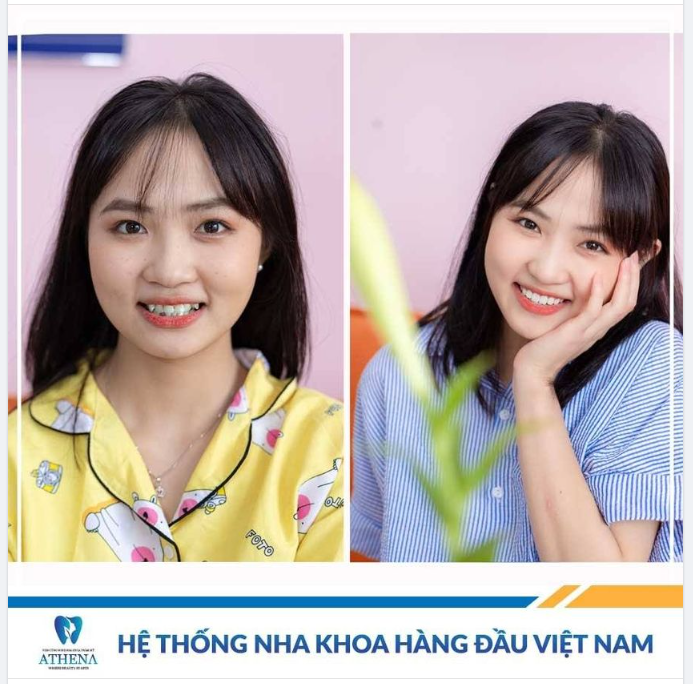 Niềng răng hôm nay - Hành trang tương lai