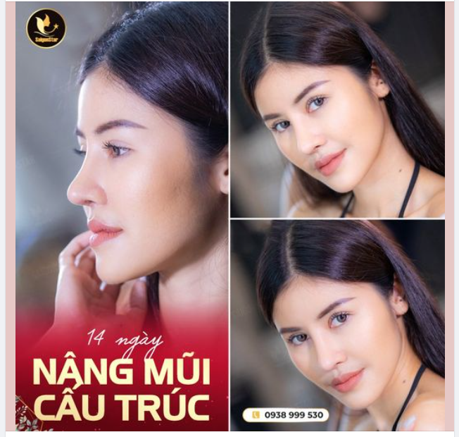14 NGÀY NÂNG MŨI CẤU TRÚC