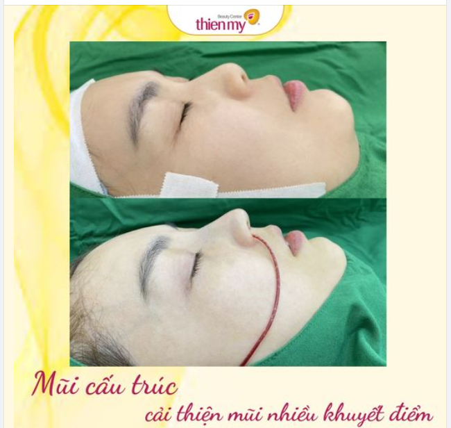 Nâng mũi cấu trúc-cải thiện mũi nhiều khuyết điểm