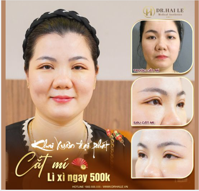 Năm cũ đã qua, năm mới đến, cớ sao chị em còn “trung thành” với cặp mí lót, không rõ nếp mí… kém duyên kia?