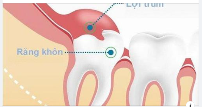 Lợi trùm răng khôn: Dấu hiệu nhận biết và cách xử trí