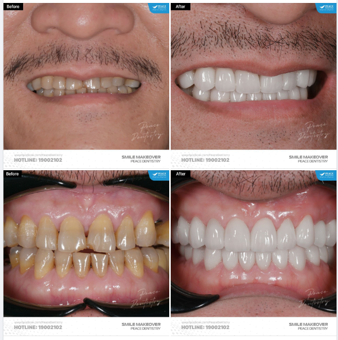 VENEER  ĐIỀU TRỊ RĂNG NHIỄM TE.TRACYCLINE