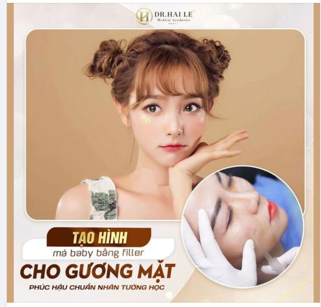 Tạo hình má baby bằng filler - Cho gương mặt phúc hậu chuẩn nhân tướng học