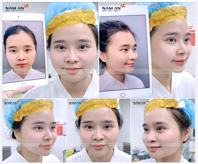 NÂNG TẦM NHAN SẮC SAU CẮT MÍ