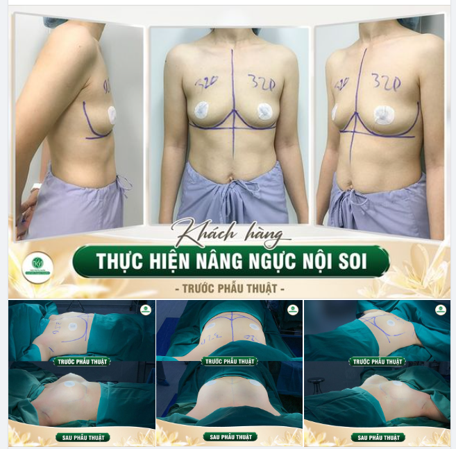 BUỔI CHIỀU NGÀY ĐẦU TUẦN: TIẾP TỤC HOÀN THÀNH XONG CA NÂNG NGỰC THỨ 4