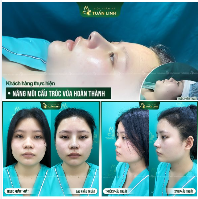 Nâng mũi cấu trúc - Ai nâng cũng đẹp - Nâng tầm nhan sắc!