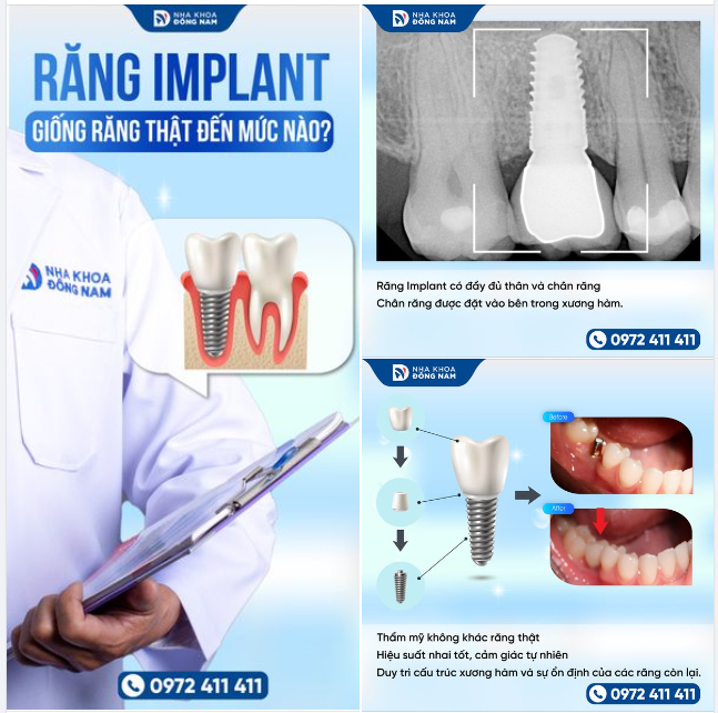 RĂNG IMPLANT GIỐNG RĂNG THẬT ĐẾN MỨC NÀO