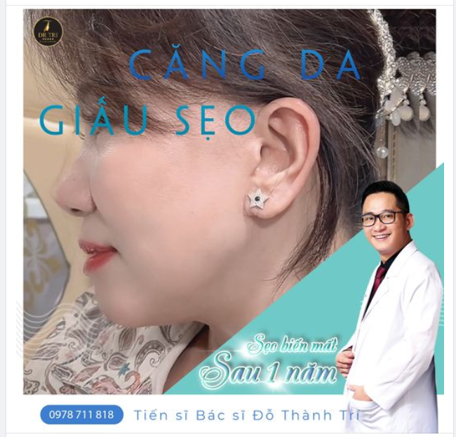 Chúc mừng cô khách. Chỉ sau 1 năm sẹo biến mất nhờ Dr.Trí trực tiếp thực hiện Căng Da Giấu Sẹo