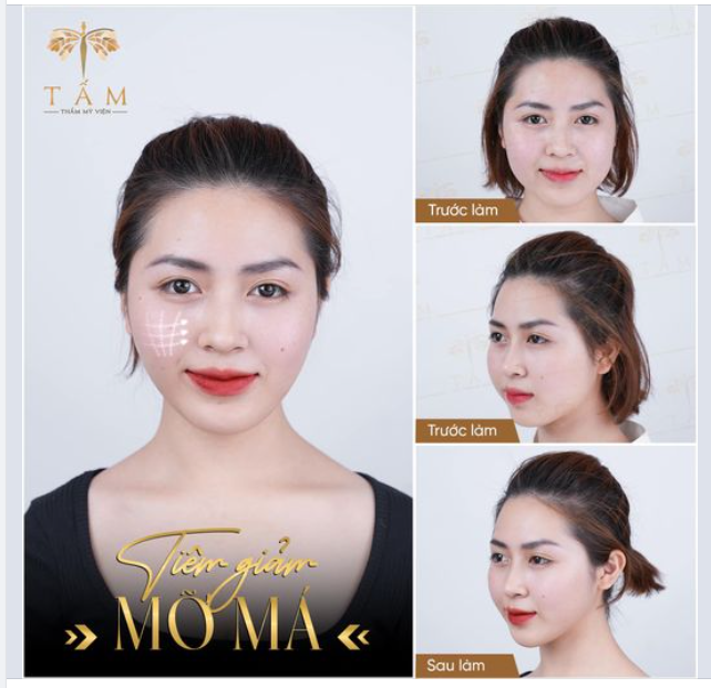 MỠ MÁ NHIỀU, MẶT TO - GIỜ ĐÂY KHÔNG CÒN LÀ VẤN ĐỀ