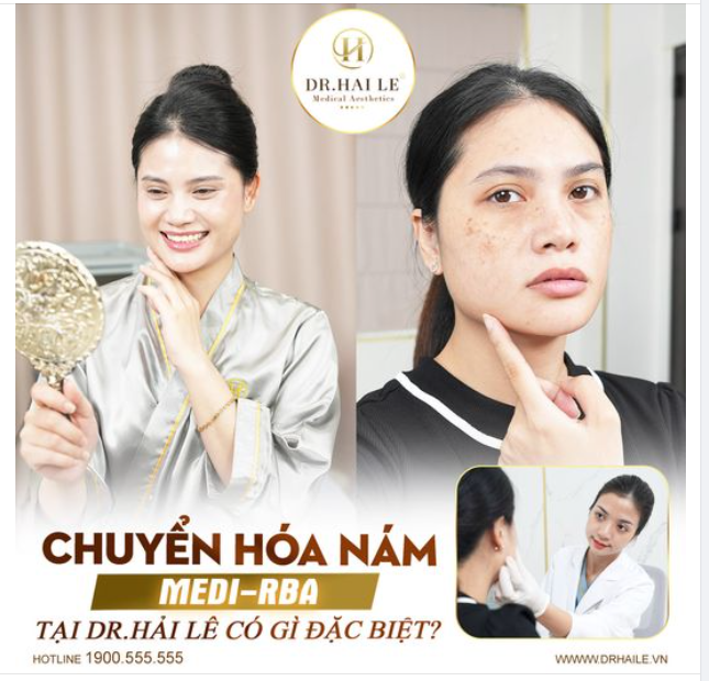 Nám da là tình trạng không ít chị em gặp phải khi bước vào độ tuổi trung niên