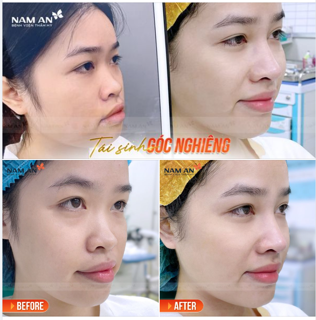 TÁI SINH GÓC NGHIÊNG ​​​​​​​ GƯƠNG MẶT THẦN THÁI