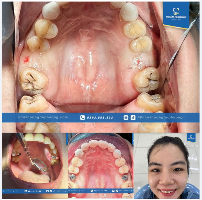 Cảnh báo: Răng 6 là răng hàm dễ hỏng nhất trong cung hàm
