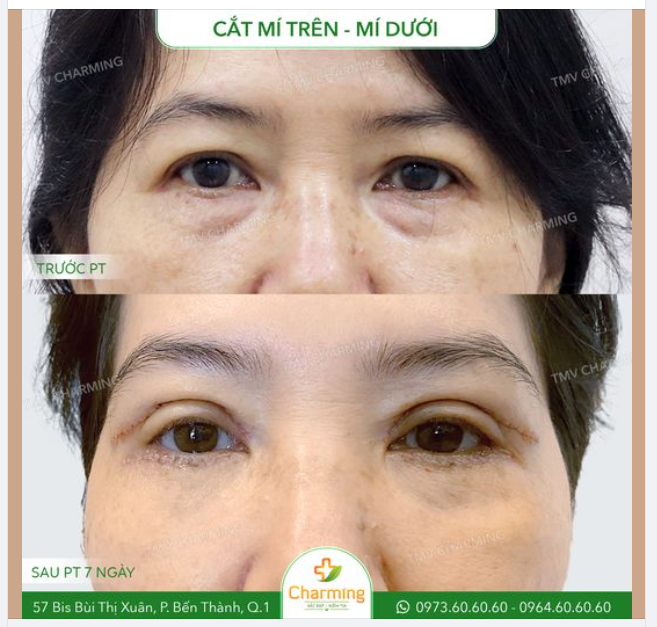 Mắt lớn tuổi là những đôi mắt "thuộc địa" của da chùng và mỡ thừa, cả mí trên lẫn mí dưới.  Và một khi tình trạng xâm nhập đã diễn ra, chúng ta phải đánh đuổi những kẻ xâm lấn này đi thôiiiii.