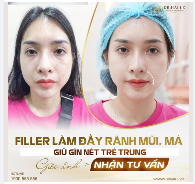 Filler làm đầy rãnh mũi, má, giữ gìn nét trẻ trung