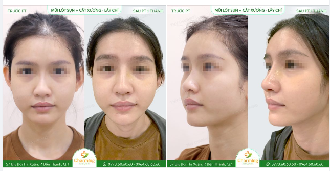 Nâng mũi chỉ là một phương pháp được nhiều cơ sở làm đẹp "tung hô" vì độ tiện dụng của nó, nhưng thật ra đây lại là một phương pháp mà giới chuyên gia khuyên mọi người không nên thực hiện.