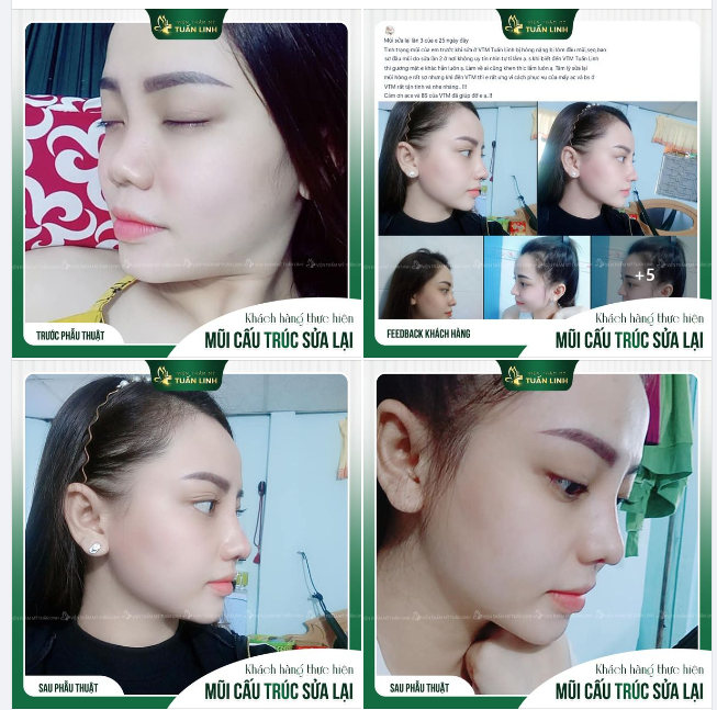 Từng nâng mũi bị "lỗi", cô nàng M.S đã tin chọn đội ngũ bác sĩ của Tuấn Linh để tái tạo mũi h.ỏng!!