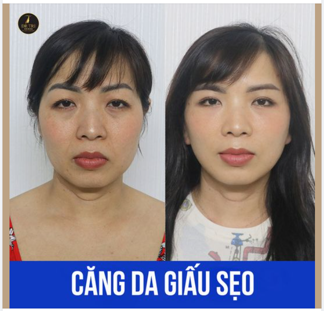 Thay đổi ngoạn mục sau CĂNG DA GIẤU SẸO