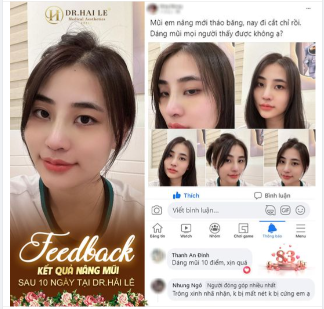 Feedback kết quả nâng mũi sau 10 ngày tại Dr Hải Lê 