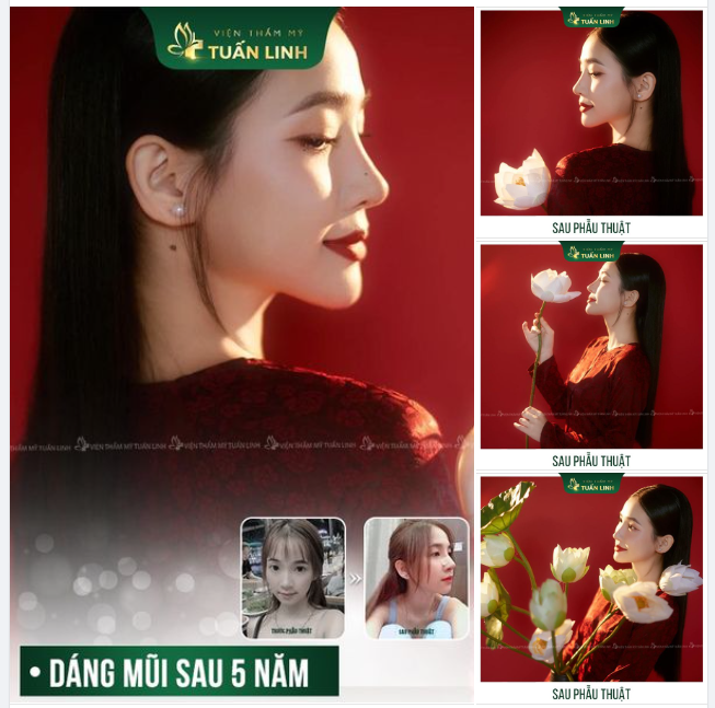 Mũi cao thon, hoàn hảo không góc chế.t - Bền đẹp dài lâu!!
