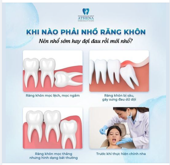 LIỆU BẠN CÓ NÊN NHỔ RĂNG KHÔN?