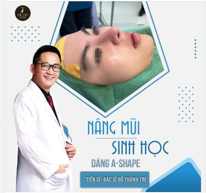 Kết thúc ca NÂNG MŨI SINH HỌC với dáng mũi cao tây, thanh thoát, hài hòa với đường nét khuôn mặt