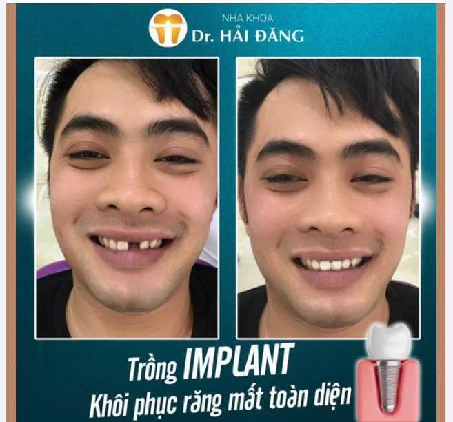 Trồng răng Implant. - "Cứu danh" cho nụ cười rặng rỡ và cuộc sống trọn vẹn