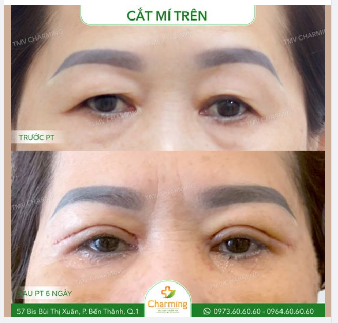 Mí sụp do tuổi tác ư? Chuyện nhỏ, vì bây giờ chúng ta đã có phương pháp cắt mí trên có thể giúp mọi người khắc phục tình trạng mí sụp làm ảnh hưởng tầm nhìn và khiến gương mặt trông lờ đờ, ủ rũ.
