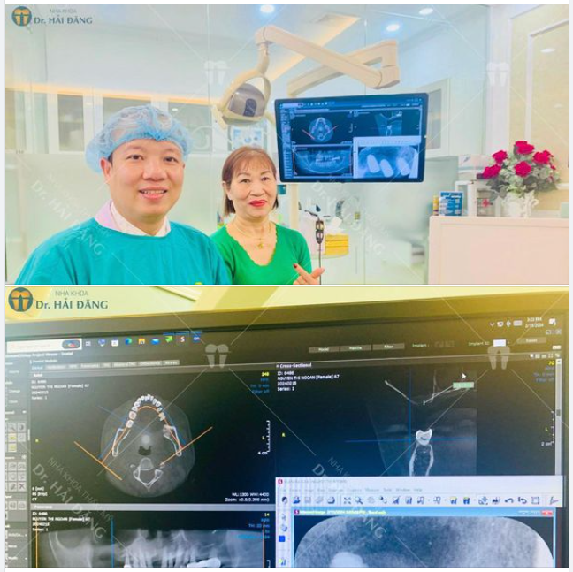 TRỒNG RĂNG IMPLANT PHỤC HÌNH VÙNG RĂNG ĂN NHAI