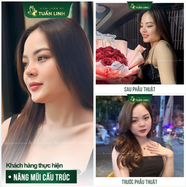 Xóa tan nỗi lo thấp tẹt kém sang Chinh phục mũi cao thon, thanh tú - Đẹp xuất sắc!