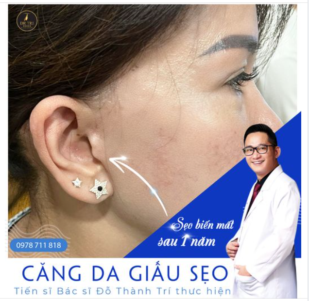 KẾT QUẢ CĂNG DA GIẤU SẸO TẠI DR.TRÍ THẾ NÀO