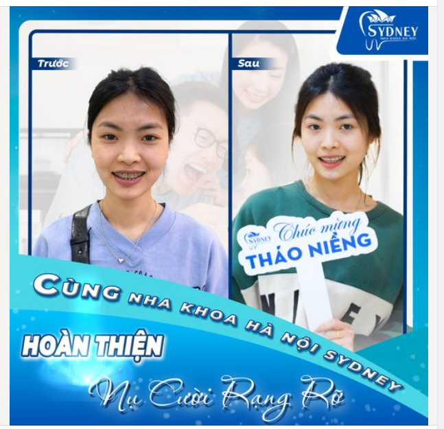 CÙNG NHA KHOA HÀ NỘI SYDNEY HOÀN THIỆN NỤ CƯỜI RẠNG RỠ!