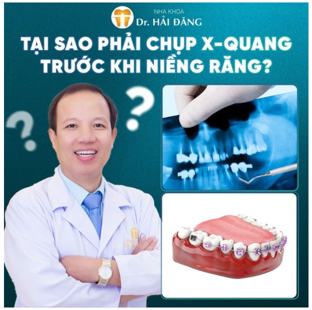 Chụp X-quang trước khi niềng răng: Tại sao lại cần thiết?
