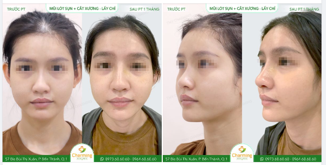 Chiếc mũi cấy chỉ trước đây đã làm nàng khách cảm thấy tự ti khi phần sóng mũi như bị thu hẹp khi nhìn chính diện, khiến phần cánh mũi như bị bè ra.