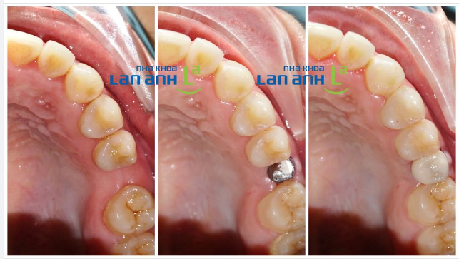 Khi khoảng mất răng nhỏ hơn bình thường, bạn vẫn có thể làm Implant được nếu không muốn làm cầu răng sứ hay niềng răng!