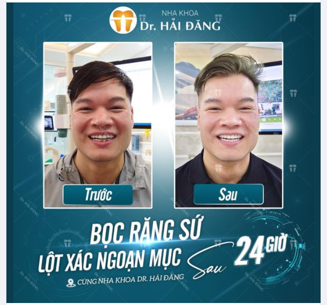 BỌC RĂNG SỨ LỘT XÁC LOẠN MỤC CHO SOÁI CA ĐÓN NỤ CƯỜI ĐẦY CÁ TÍNH