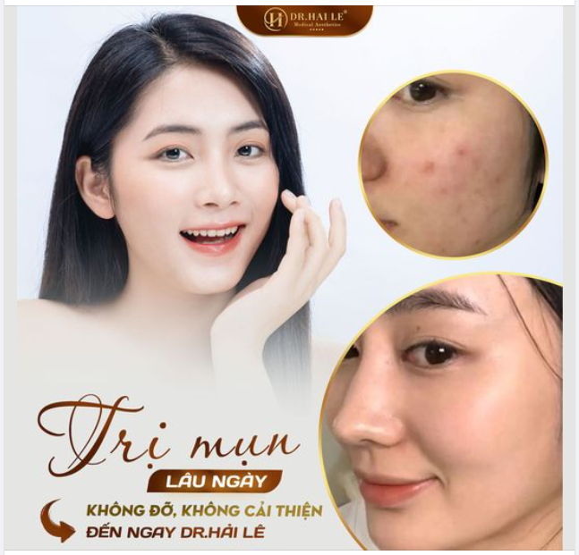 Trị mụn lâu ngày không đỡ, không cải thiện Đêna ngay Dr Hải Lê