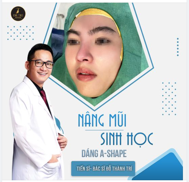 Nâng Mũi Sinh Học tại Dr.Trí: Chỉ có Đẹp Sang không Sến