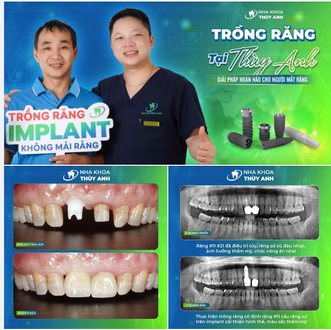 CÁCH CHĂM SÓC RĂNG MIỆNG SAU TRỒNG RĂNG IMPLANT