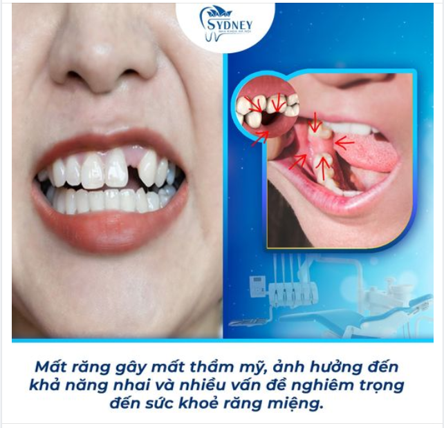 HẬU QUẢ NGHIÊM TRỌNG KHI MẤT RĂNG