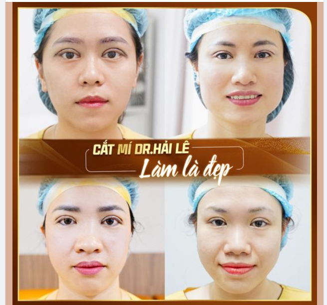 Sở hữu cặp mắt phượng 2 nếp mí là mong muốn của không ít chị em có cặp mí lót, một mí, đa nếp mí…