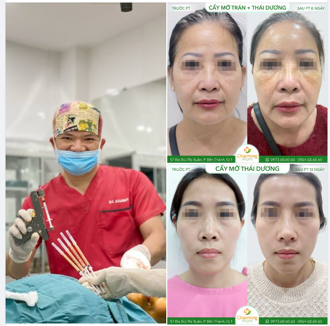 LIỆU CÓ AN TOÀN KHI CẤY MỠ TỰ THÂN VÙNG THÁI DƯƠNG?