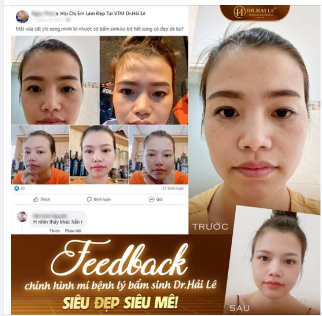 Chị khách đến Dr.Hải Lê chỉnh mí bệnh lý bẩm sinh với mong muốn có được ...