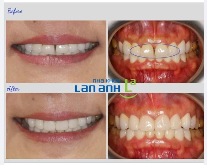 Răng sứ cũ bị hở kẽ không chỉ làm mất đi vẻ đẹp tự nhiên của nụ cười mà còn có thể gây ra những vấn đề sức khỏe răng miệng như dễ tích tụ vi khuẩn gây viêm nướu, nhét thức ăn khó vệ sinh... và nhiều vấn đề khác nếu không được khắc phục kịp thời.