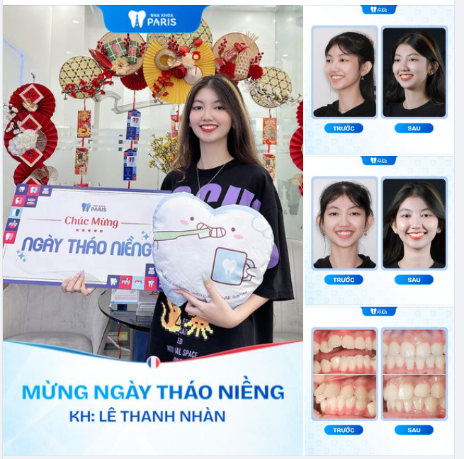 Hoàn thành liệu trình niềng răng 18 tháng cho cô gái xinh đẹp!