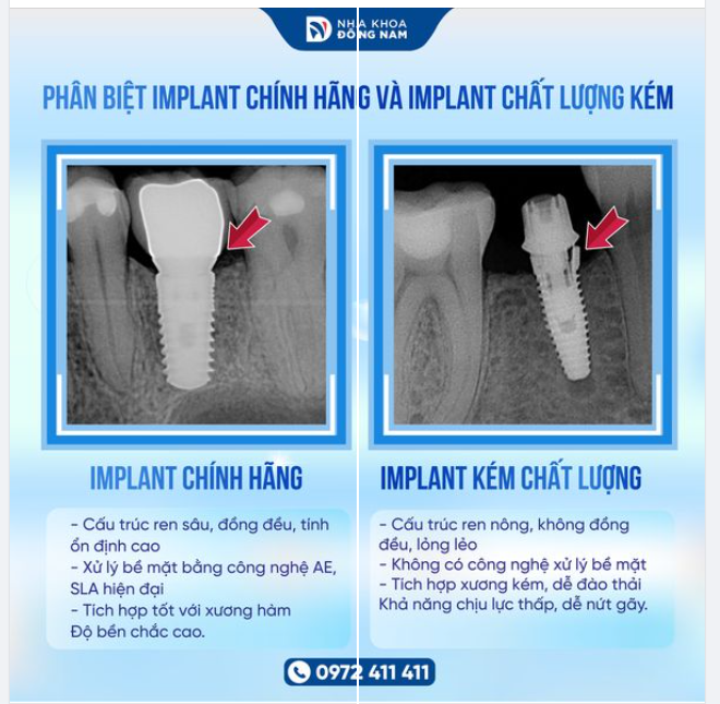 IMPLANT CHẤT LƯỢNG KÉM: LIỆU BẠN CÓ THỂ TỰ PHÂN BIỆT
