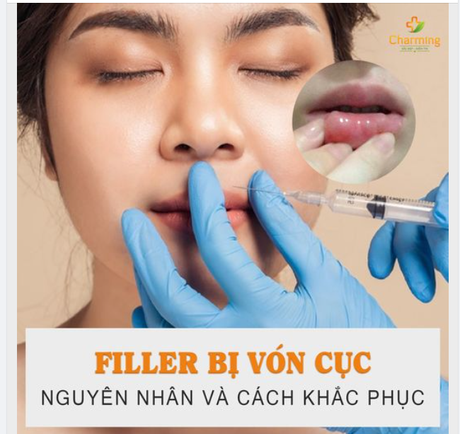 FILLER BỊ VÓN CỤC - NGUYÊN NHÂN VÀ CÁCH KHẮC PHỤC