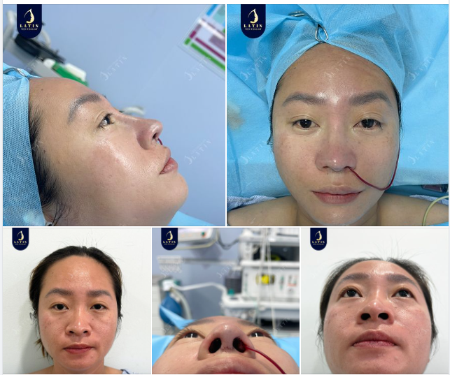 Tái tạo dáng mũi mới cho chị gái