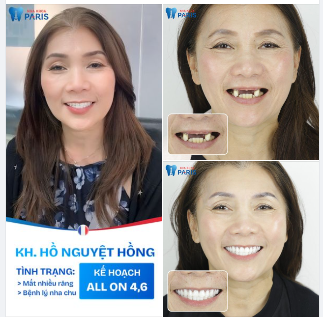 VIỆT KIỀU ÚC VỀ VIỆT NAM TRỒNG RĂNG VÀ KẾT QUẢ MÃN NGUYỆN!