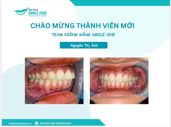 Chào mừng Ánh đến với Team niềng răng Smile One!